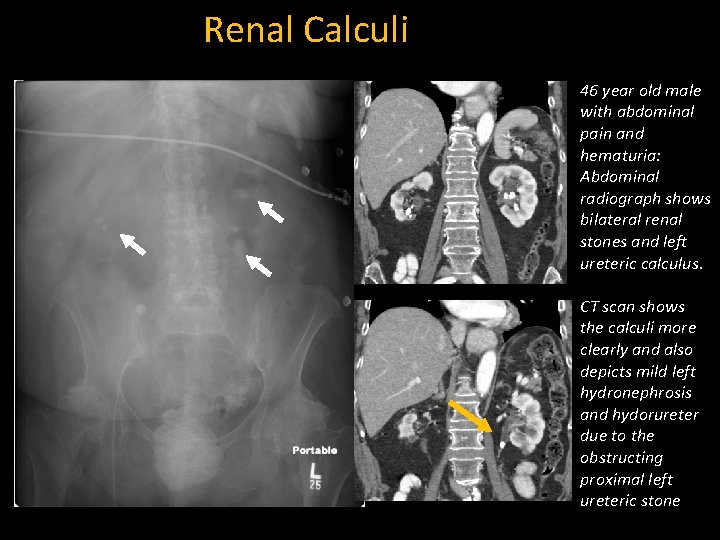 Renal Calculi 46 year old male with abdominal pain and hematuria: Abdominal radiograph shows