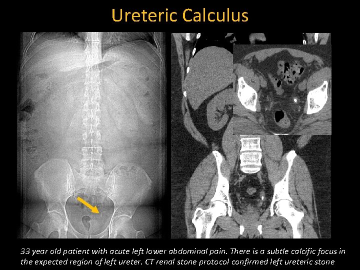 Ureteric Calculus 33 year old patient with acute left lower abdominal pain. There is