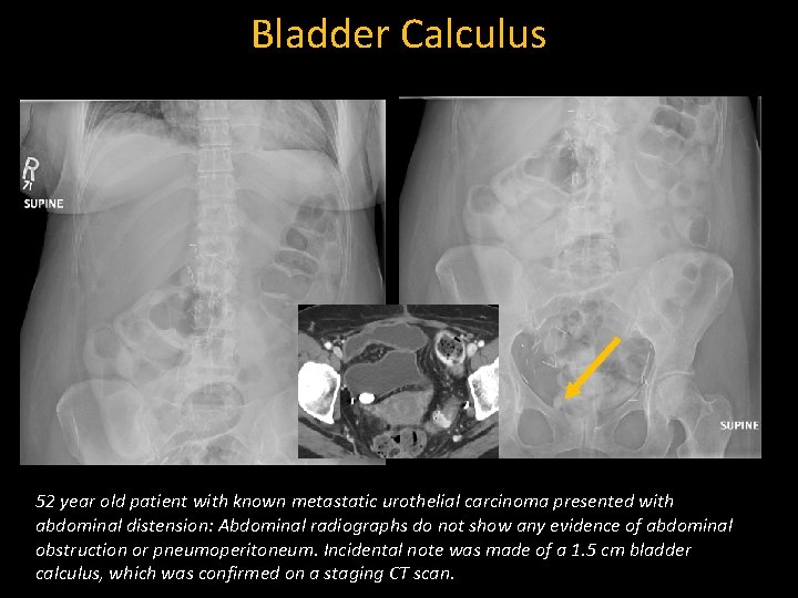 Bladder Calculus 52 year old patient with known metastatic urothelial carcinoma presented with abdominal