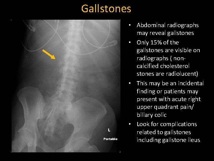 Gallstones • Abdominal radiographs may reveal gallstones • Only 15% of the gallstones are