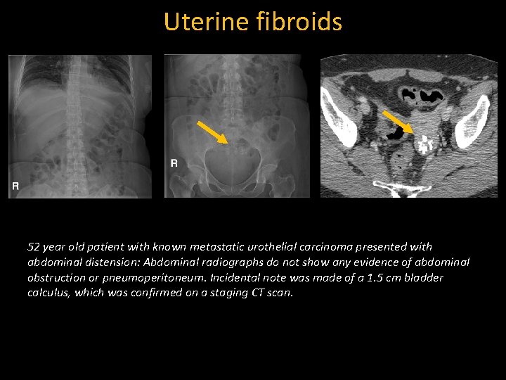 Uterine fibroids 52 year old patient with known metastatic urothelial carcinoma presented with abdominal