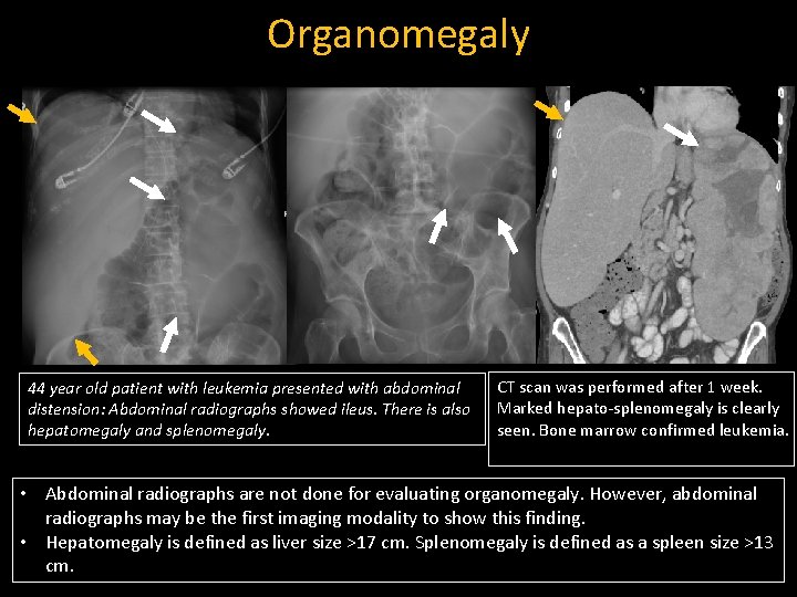 Organomegaly 44 year old patient with leukemia presented with abdominal distension: Abdominal radiographs showed