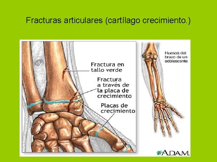 Fracturas articulares (cartílago crecimiento. ) 