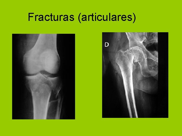 Fracturas (articulares) 