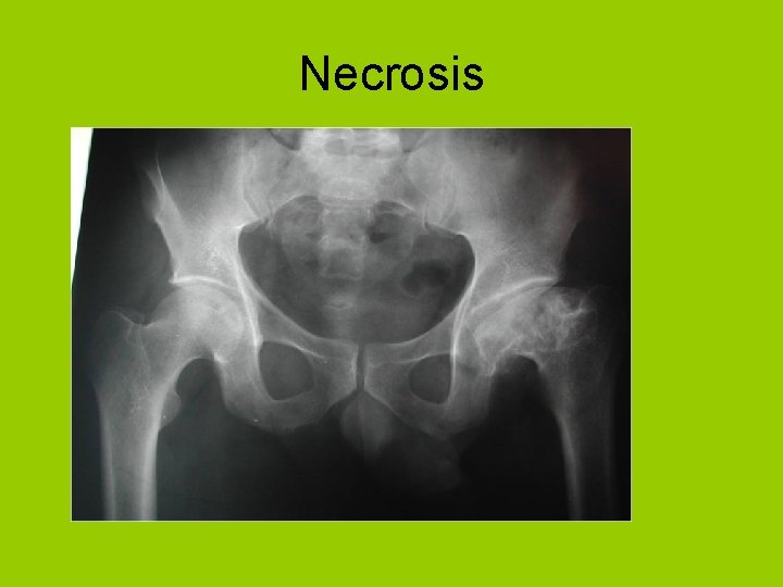 Necrosis 