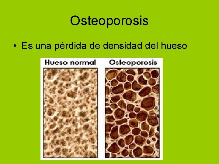 Osteoporosis • Es una pérdida de densidad del hueso 