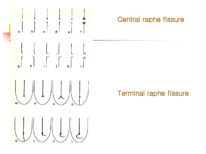 Central raphe fissure Terminal raphe fissure 