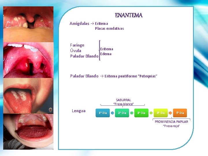 Amígdalas Eritema Placas exudativas Farínge Eritema Úvula Edema Paladar Blando Eritema puntiforme “Petequias” SABURRAL