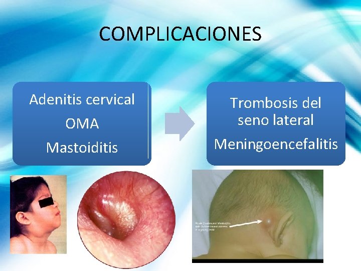 COMPLICACIONES Adenitis cervical OMA Trombosis del seno lateral Mastoiditis Meningoencefalitis 