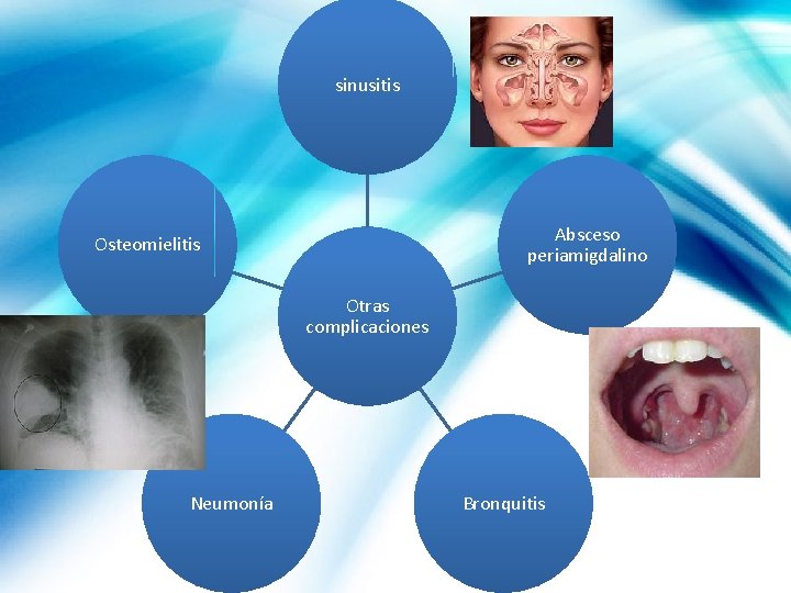 sinusitis Absceso periamigdalino Osteomielitis Otras complicaciones Neumonía Bronquitis 
