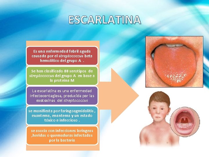 ESCARLATINA Es una enfermedad febril aguda causada por el streptococcus beta hemolítico del grupo