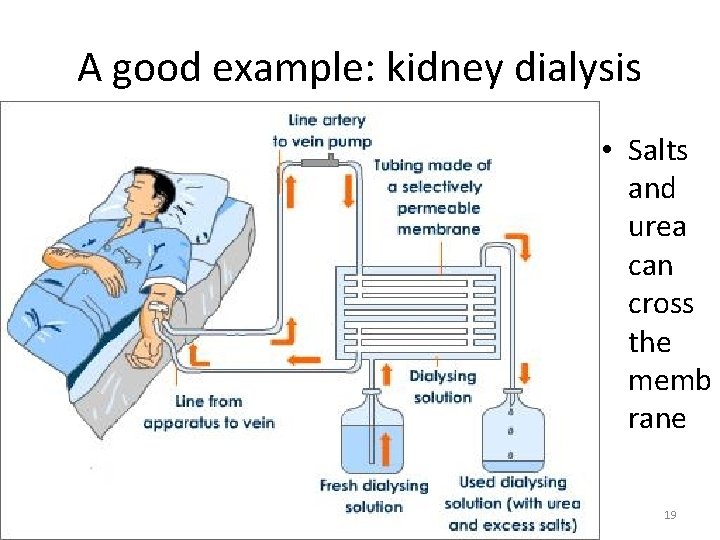 A good example: kidney dialysis • Salts and urea can cross the memb rane