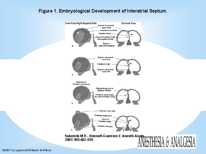 Figure 1. Embryological Development of Interatrial Septum. Sukernik M R , Bennett-Guerrero E Anesth