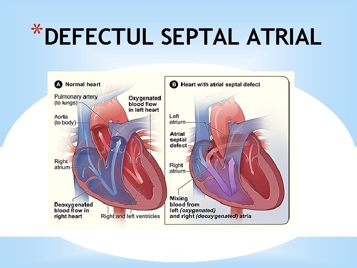 *DEFECTUL SEPTAL ATRIAL 