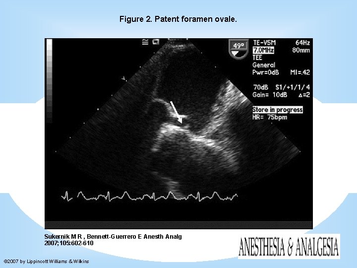 Figure 2. Patent foramen ovale. Sukernik M R , Bennett-Guerrero E Anesth Analg 2007;