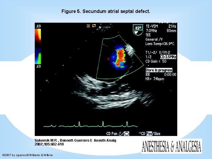 Figure 5. Secundum atrial septal defect. Sukernik M R , Bennett-Guerrero E Anesth Analg