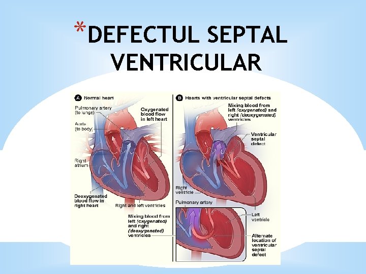 *DEFECTUL SEPTAL VENTRICULAR 