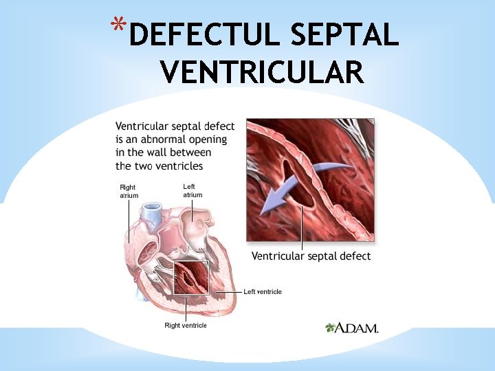 *DEFECTUL SEPTAL VENTRICULAR 