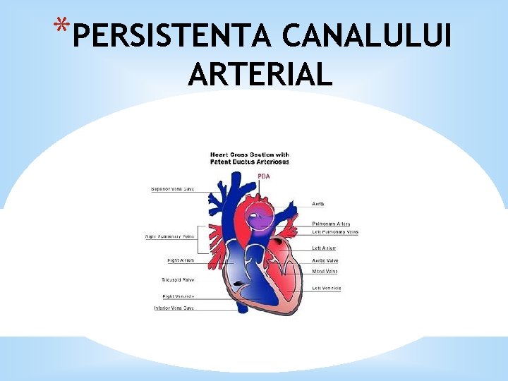 *PERSISTENTA CANALULUI ARTERIAL 