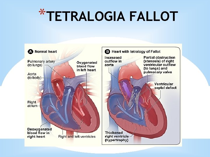 *TETRALOGIA FALLOT 