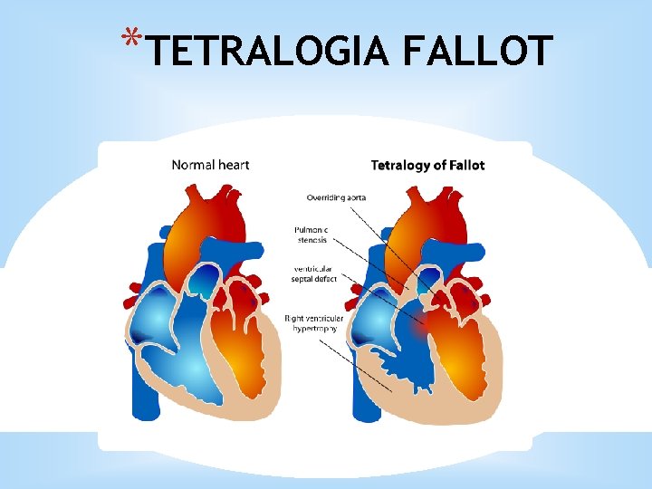 *TETRALOGIA FALLOT 