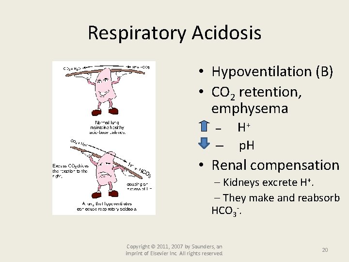 Respiratory Acidosis • Hypoventilation (B) • CO 2 retention, emphysema – – H+ p.