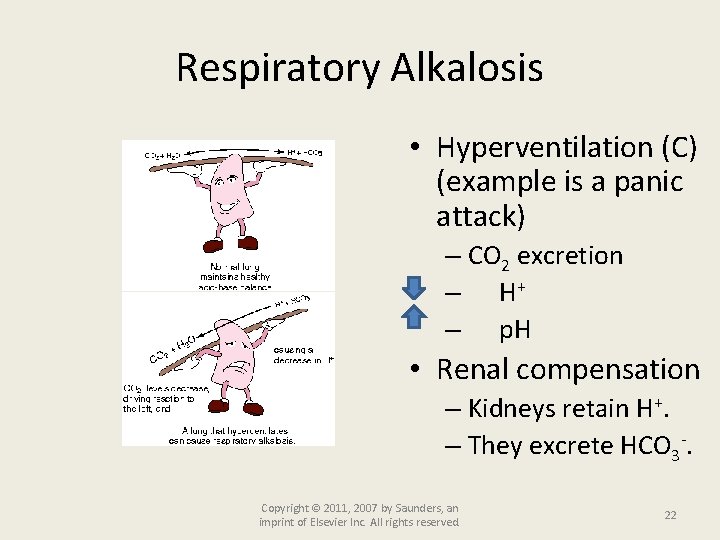 Respiratory Alkalosis • Hyperventilation (C) (example is a panic attack) – CO 2 excretion