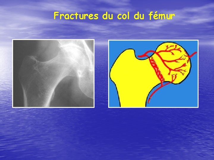 Fractures du col du fémur 