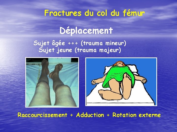 Fractures du col du fémur Déplacement Sujet âgée +++ (trauma mineur) Sujet jeune (trauma