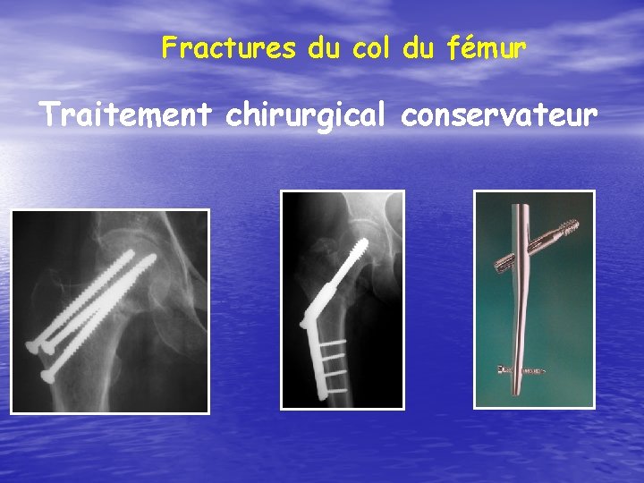 Fractures du col du fémur Traitement chirurgical conservateur 
