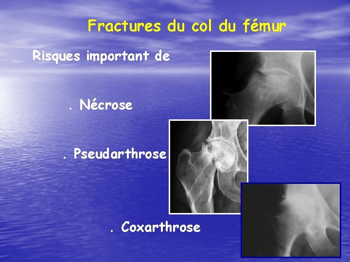 Fractures du col du fémur Risques important de. Nécrose. Pseudarthrose . Coxarthrose 