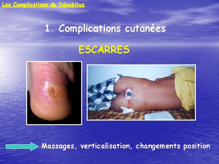 Les Complications du Décubitus 1. Complications cutanées ESCARRES Massages, verticalisation, changements position 