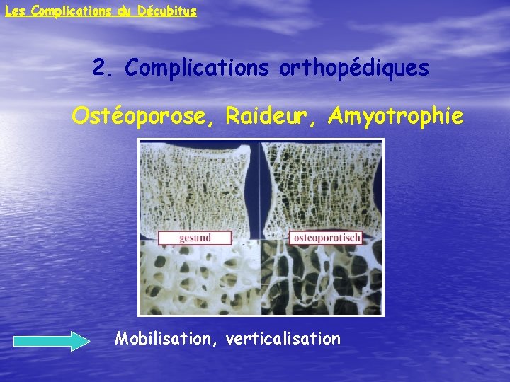 Les Complications du Décubitus 2. Complications orthopédiques Ostéoporose, Raideur, Amyotrophie Mobilisation, verticalisation 