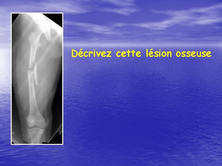 Décrivez cette lésion osseuse 