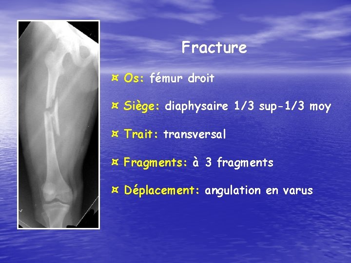 Fracture ¤ Os: fémur droit ¤ Siège: diaphysaire 1/3 sup-1/3 moy ¤ Trait: transversal