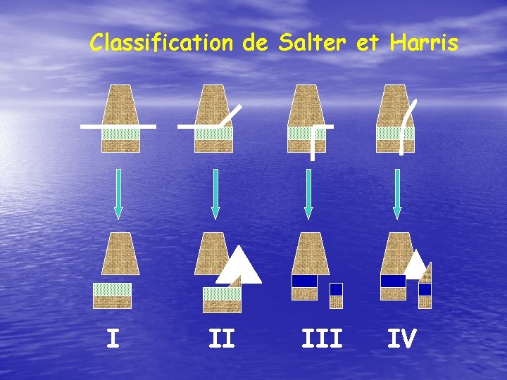 Classification de Salter et Harris I II IV 