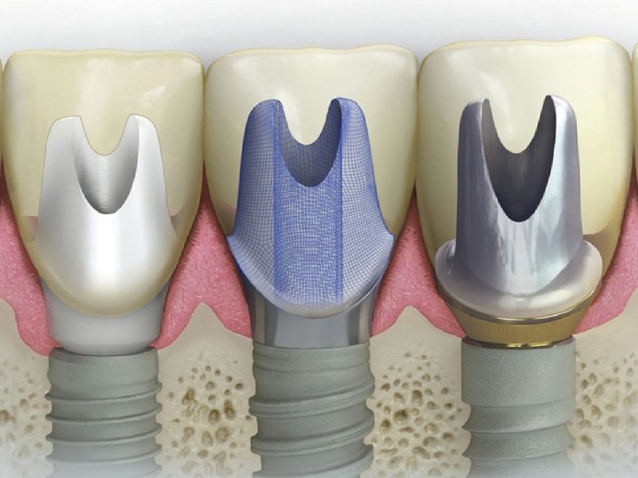 Contents 1 Implant Abutment Materials 2 General Information