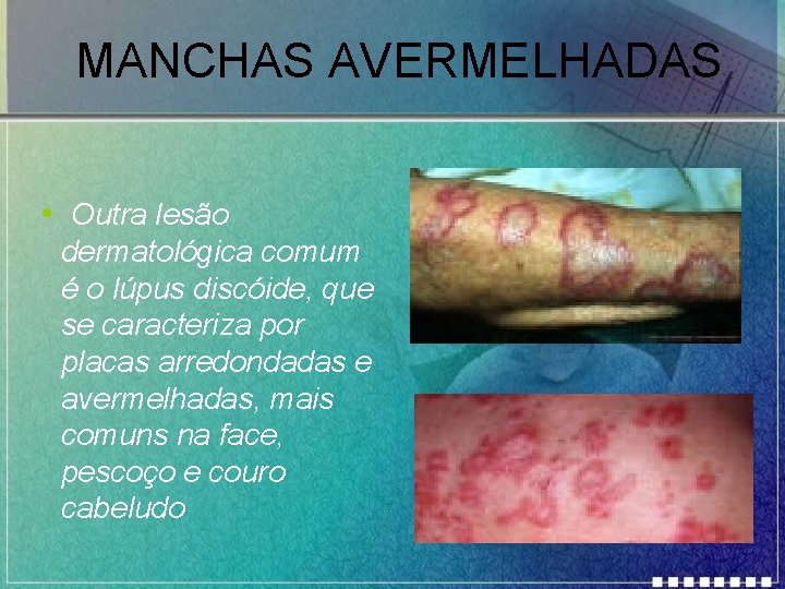 MANCHAS AVERMELHADAS • Outra lesão dermatológica comum é o lúpus discóide, que se caracteriza