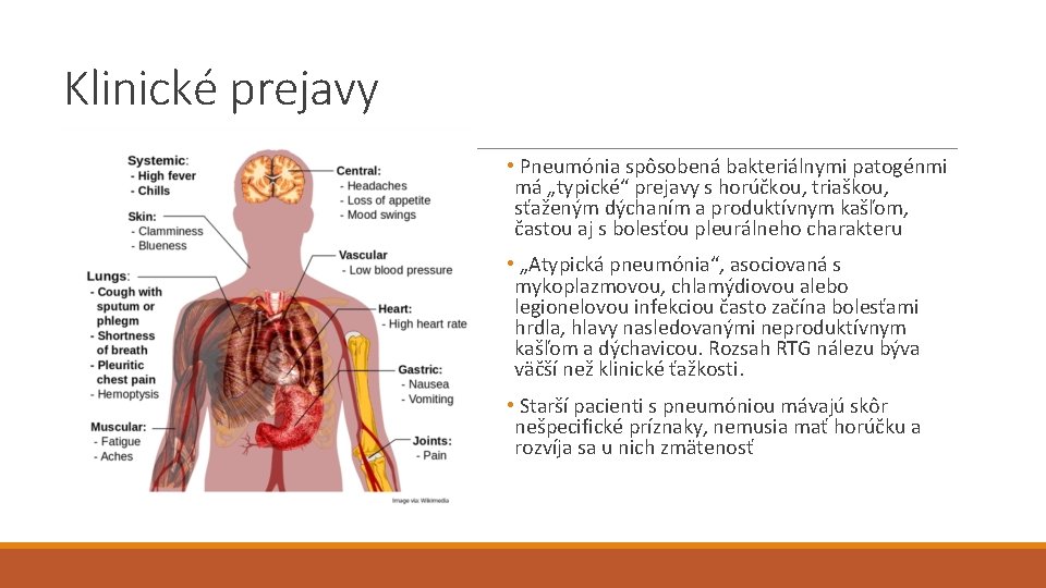 Klinické prejavy • Pneumónia spôsobená bakteriálnymi patogénmi má „typické“ prejavy s horúčkou, triaškou, sťaženým