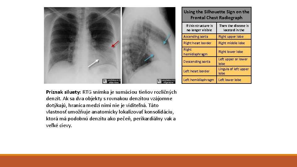 Using the Silhouette Sign on the Frontal Chest Radiograph If this structure is no