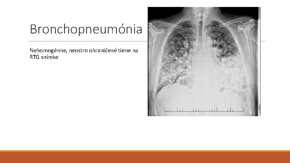 Bronchopneumónia Nehomogénne, neostro ohraničené tiene na RTG snímke 