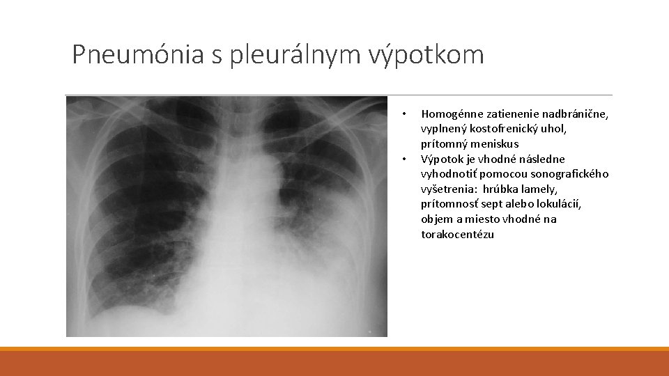 Pneumónia s pleurálnym výpotkom • • Homogénne zatienenie nadbránične, vyplnený kostofrenický uhol, prítomný meniskus