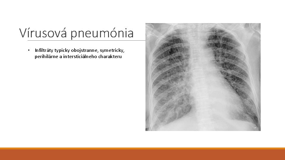 Vírusová pneumónia • Infiltráty typicky obojstranne, symetricky, perihilárne a intersticiálneho charakteru 