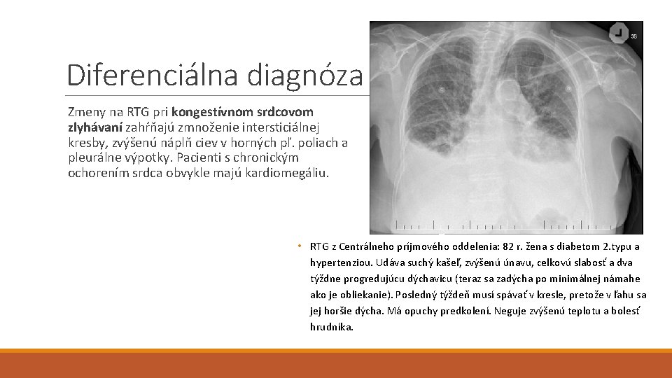 Diferenciálna diagnóza Zmeny na RTG pri kongestívnom srdcovom zlyhávaní zahŕňajú zmnoženie intersticiálnej kresby, zvýšenú