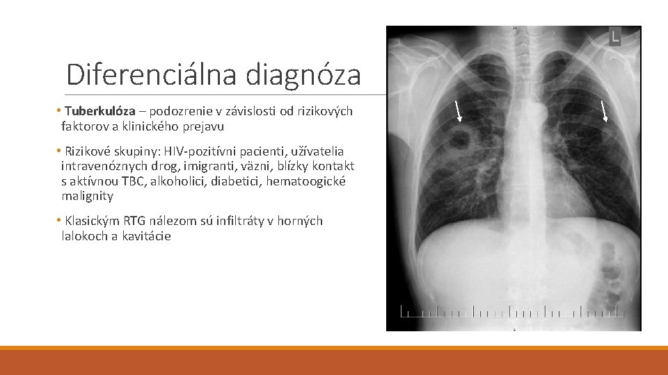 Diferenciálna diagnóza • Tuberkulóza – podozrenie v závislosti od rizikových faktorov a klinického prejavu