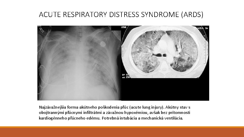ACUTE RESPIRATORY DISTRESS SYNDROME (ARDS) Najzávažnejšia forma akútneho poškodenia pľúc (acute lung injury). Akútny