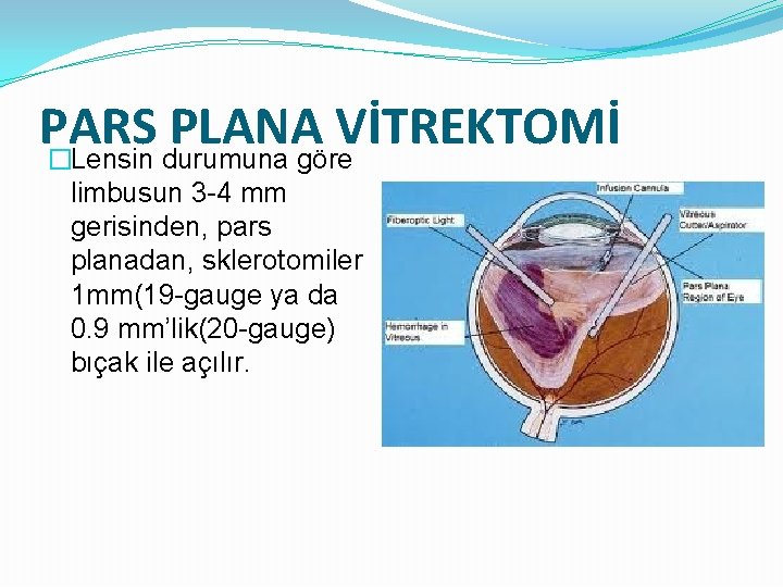 PARS PLANA VİTREKTOMİ �Lensin durumuna göre limbusun 3 -4 mm gerisinden, pars planadan, sklerotomiler