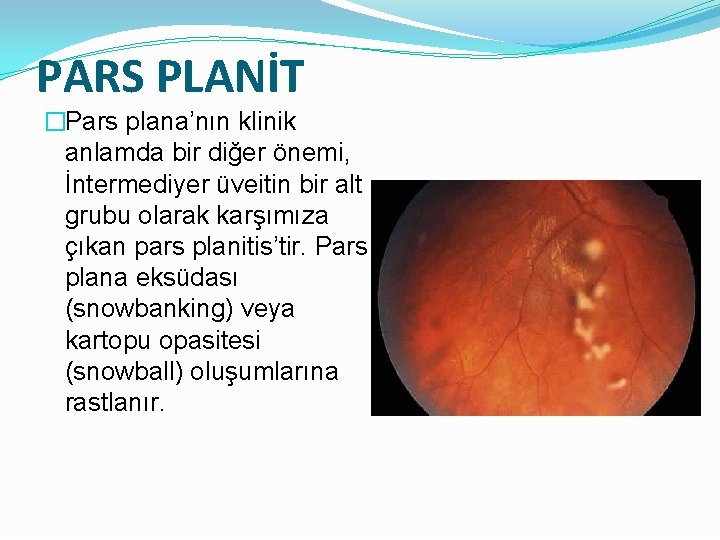 PARS PLANİT �Pars plana’nın klinik anlamda bir diğer önemi, İntermediyer üveitin bir alt grubu