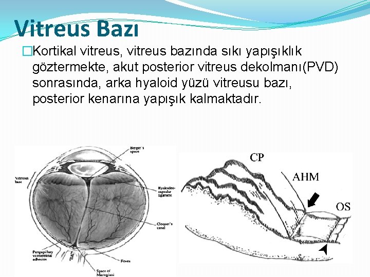 Vitreus Bazı �Kortikal vitreus, vitreus bazında sıkı yapışıklık göztermekte, akut posterior vitreus dekolmanı(PVD) sonrasında,