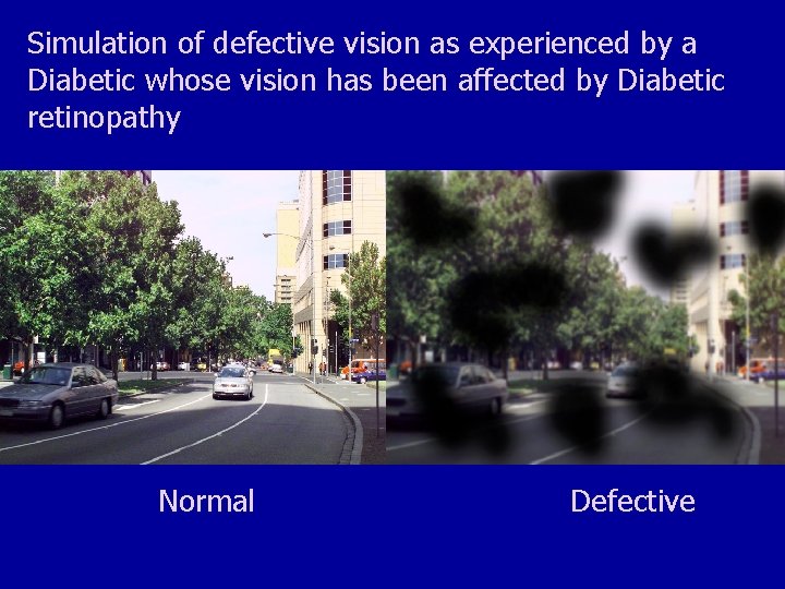 Simulation of defective vision as experienced by a Diabetic whose vision has been affected
